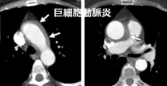 巨細胞動脈炎 胸部造影CT 巨細胞動脈炎 胸部造影CT