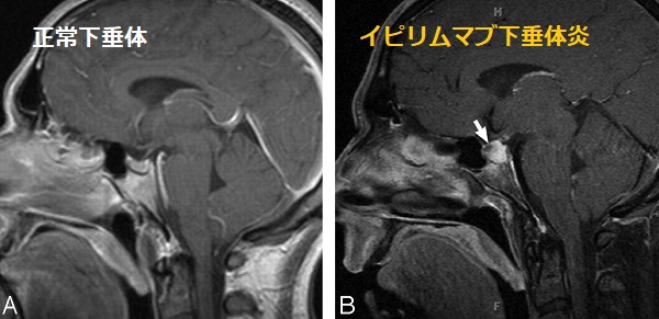 イピリムマブ MRI 造影T1強調像 イピリムマブ MRI 造影T1強調像