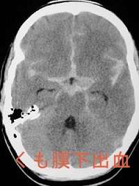甲状腺機能亢進症/バセドウ病と、くも膜下出血 甲状腺機能亢進症/バセドウ病と、くも膜下出血