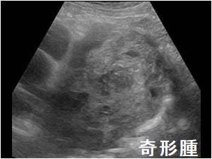 奇形腫 超音波(エコー)画像 奇形腫 超音波(エコー)画像