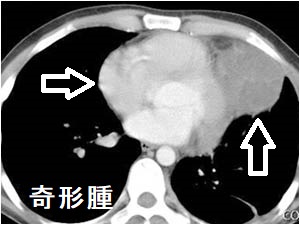 奇形腫 CT画像 奇形腫 CT画像