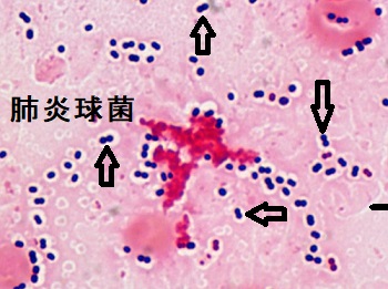 甲状腺と肺炎球菌 甲状腺と肺炎球菌