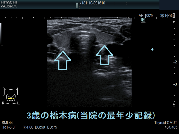 3歳の橋本病 超音波(エコー)画像 3歳の橋本病 超音波(エコー)画像
