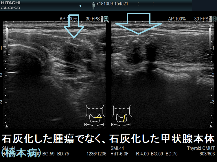 石灰化した甲状腺本体の超音波(エコー)画像 石灰化した甲状腺本体の超音波(エコー)画像