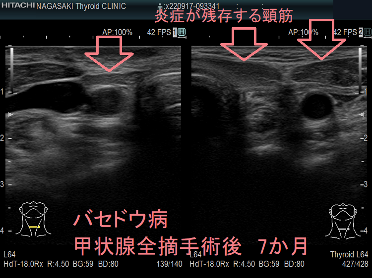 バセドウ病 甲状腺全摘手術後 7か月 超音波(エコー)画像 バセドウ病 甲状腺全摘手術後 7か月 超音波(エコー)画像