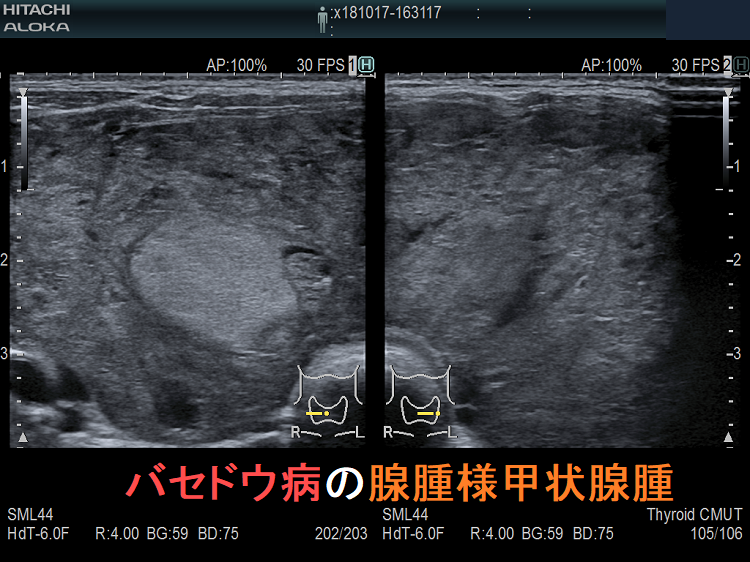 バセドウ病の腺腫様甲状腺腫 超音波(エコー)画像 バセドウ病の腺腫様甲状腺腫 超音波(エコー)画像