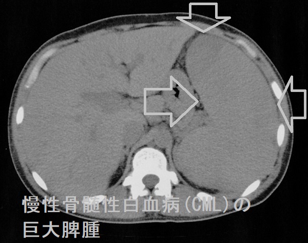 慢性骨髄性白血病(CML) 巨大脾腫 慢性骨髄性白血病(CML) 巨大脾腫
