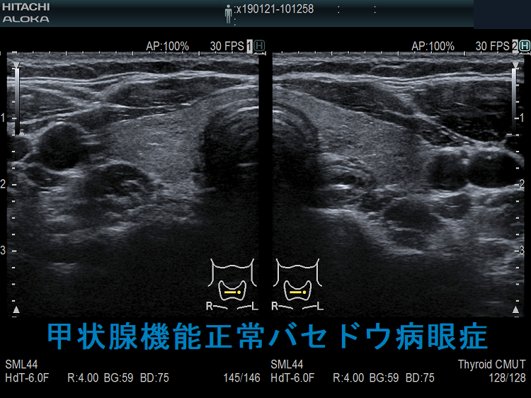 甲状腺機能正常バセドウ病眼症 超音波(エコー)画像 甲状腺機能正常バセドウ病眼症 超音波(エコー)画像