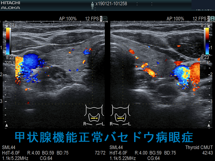 甲状腺機能正常バセドウ病眼症 超音波(エコー)ドプラー 甲状腺機能正常バセドウ病眼症 超音波(エコー)ドプラー