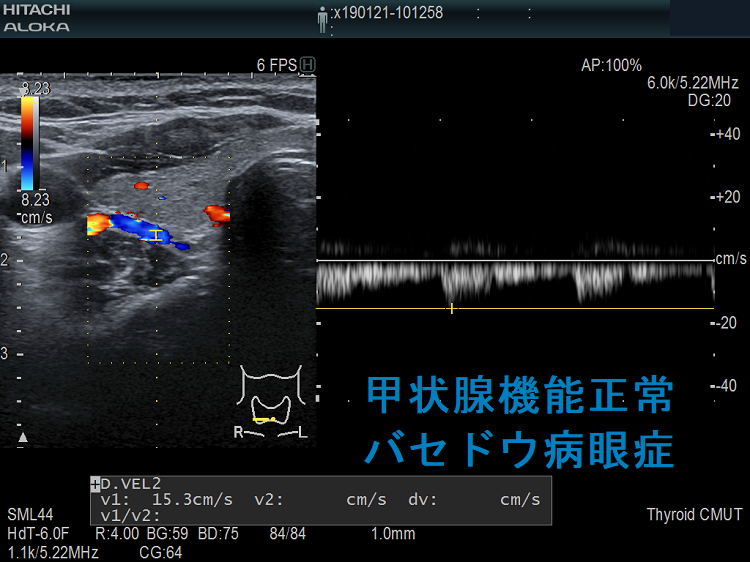 甲状腺機能正常バセドウ病眼症 下甲状腺動脈血流速度(ITA-PSV) 甲状腺機能正常バセドウ病眼症 下甲状腺動脈血流速度(ITA-PSV)