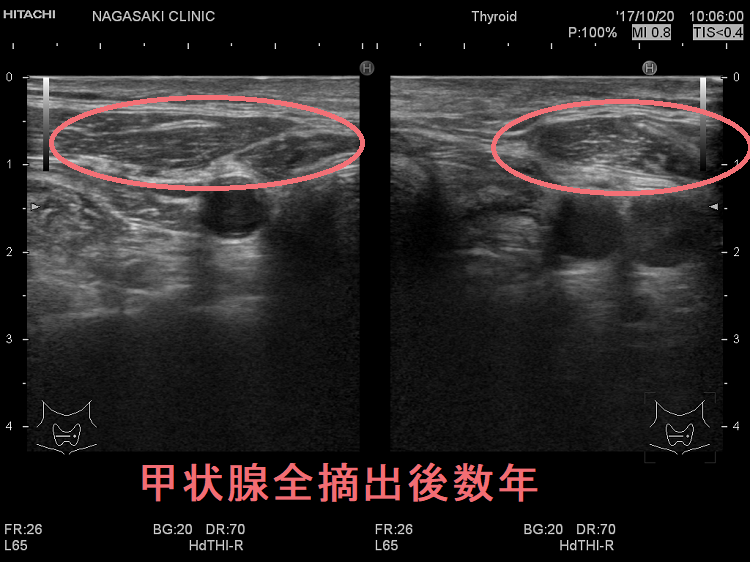 甲状腺全摘出後数年 超音波(エコー)画像 甲状腺全摘出後数年 超音波(エコー)画像