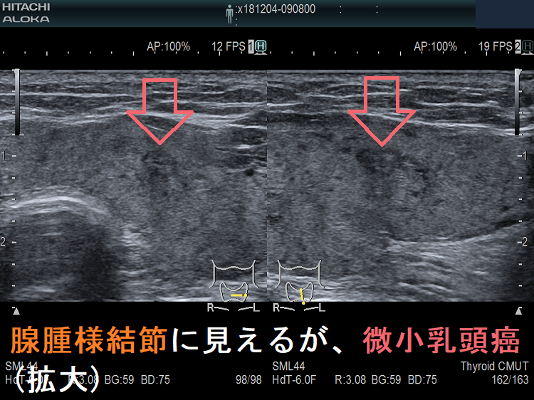 腺腫様結節に見えるが、微小乳頭がん(拡大) 腺腫様結節に見えるが、微小乳頭がん(拡大)