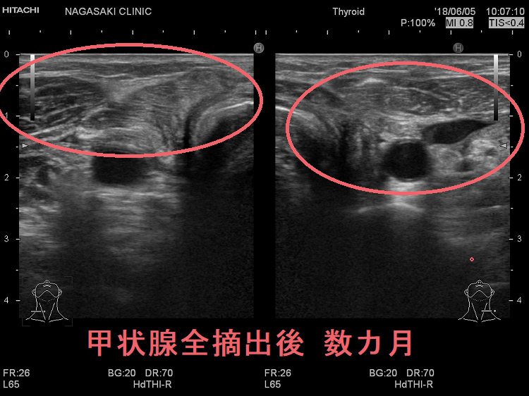 甲状腺全摘出後 数カ月 超音波(エコー)画像 甲状腺全摘出後 数カ月 超音波(エコー)画像