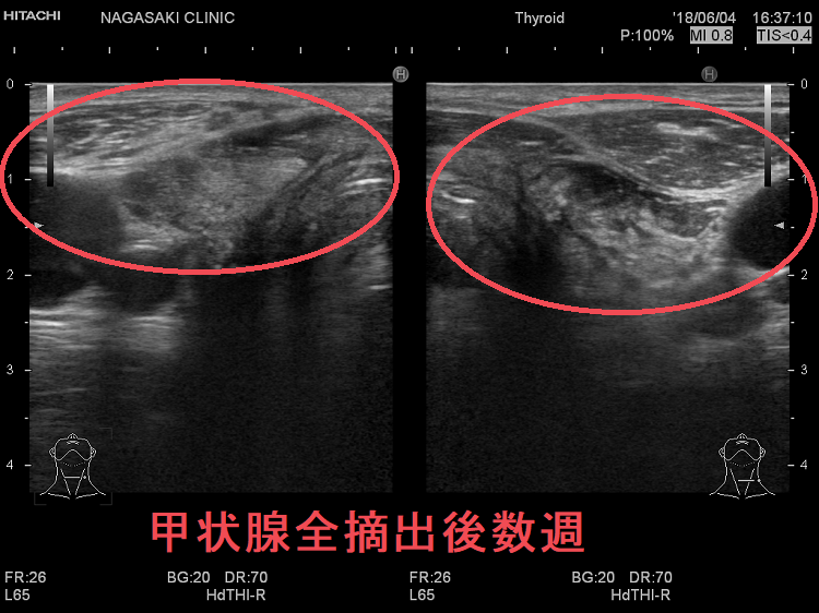 甲状腺全摘出後数週 超音波(エコー)画像 甲状腺全摘出後数週 超音波(エコー)画像