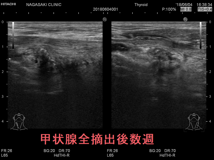 甲状腺全摘出後数週 超音波(エコー)画像 甲状腺全摘出後数週 (垂直断)超音波(エコー)画像