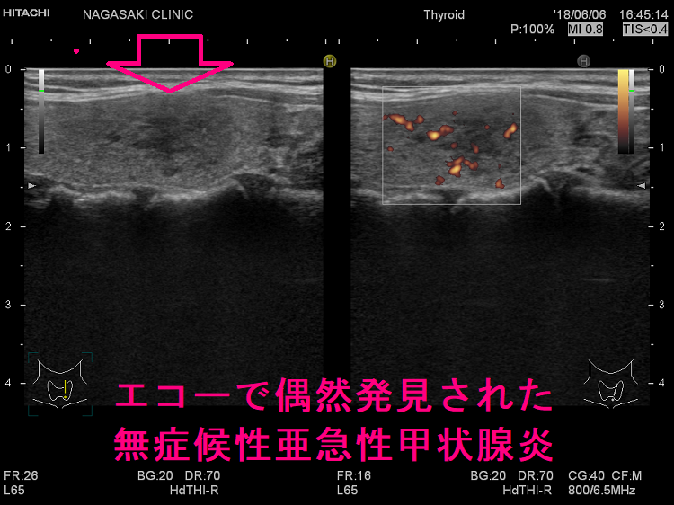 エコーで偶然発見された無症候性亜急性甲状腺炎 エコーで偶然発見された無症候性亜急性甲状腺炎
