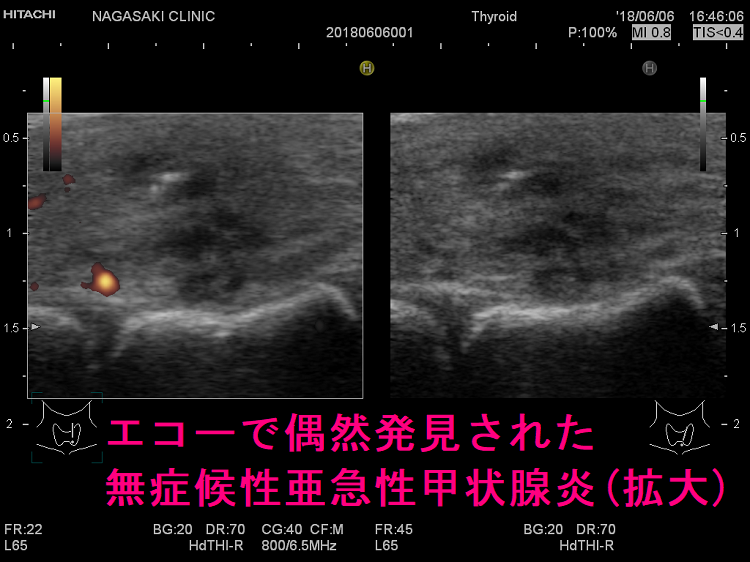エコーで偶然発見された無症候性亜急性甲状腺炎(拡大) エコーで偶然発見された無症候性亜急性甲状腺炎(拡大)