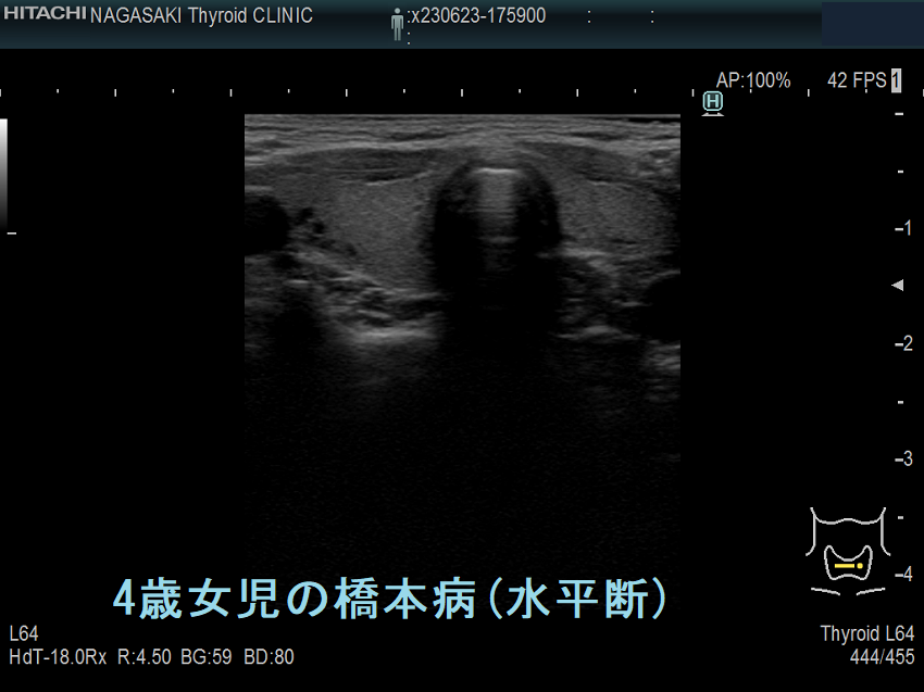 4歳女児の橋本病 超音波(エコー)画像 (水平断) 4歳女児の橋本病 超音波(エコー)画像 (水平断)