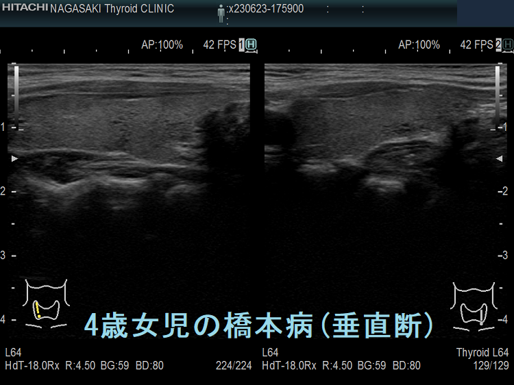 4歳女児の橋本病 超音波(エコー)画像 (垂直断) 4歳女児の橋本病 超音波(エコー)画像 (垂直断)