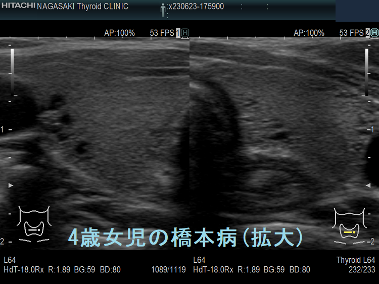 4歳女児の橋本病 超音波(エコー)画像 (拡大) 4歳女児の橋本病 超音波(エコー)画像 (拡大)
