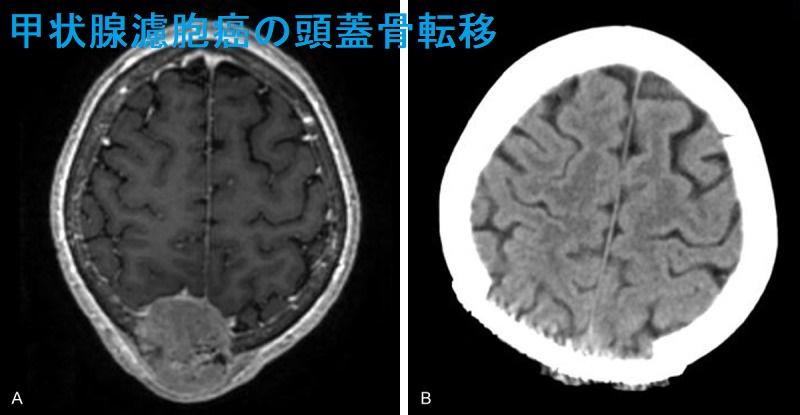甲状腺濾胞癌の頭蓋骨転移 MRI画像 甲状腺濾胞癌の頭蓋骨転移 MRI画像