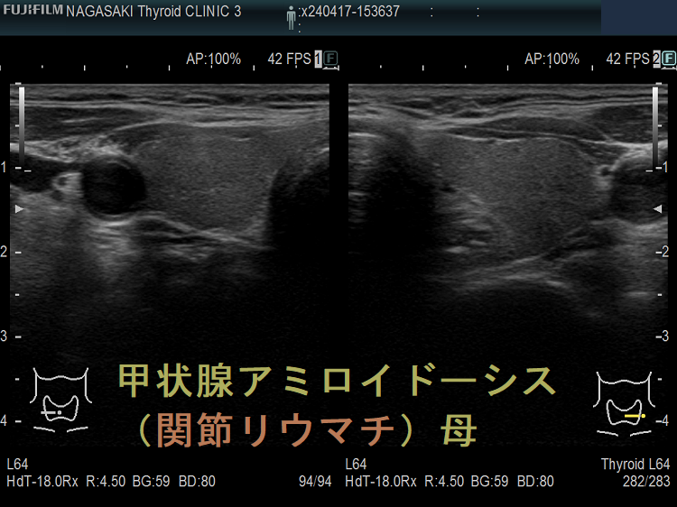 甲状腺アミロイドーシス(関節リウマチ)母 甲状腺アミロイドーシス(関節リウマチ)母