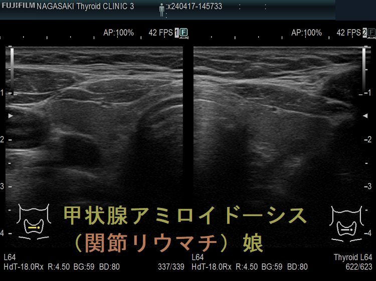 甲状腺アミロイドーシス(関節リウマチ)娘 甲状腺アミロイドーシス(関節リウマチ)娘