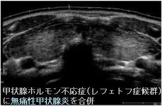 甲状腺ホルモン不応症(レフェトフ症候群)に橋本病、無痛性甲状腺炎を合併 甲状腺ホルモン不応症(レフェトフ症候群)に橋本病、無痛性甲状腺炎を合併