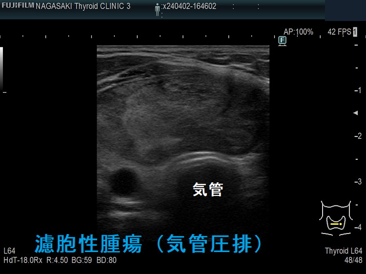 濾胞性腫瘍(気管圧排) 濾胞性腫瘍(気管圧排)