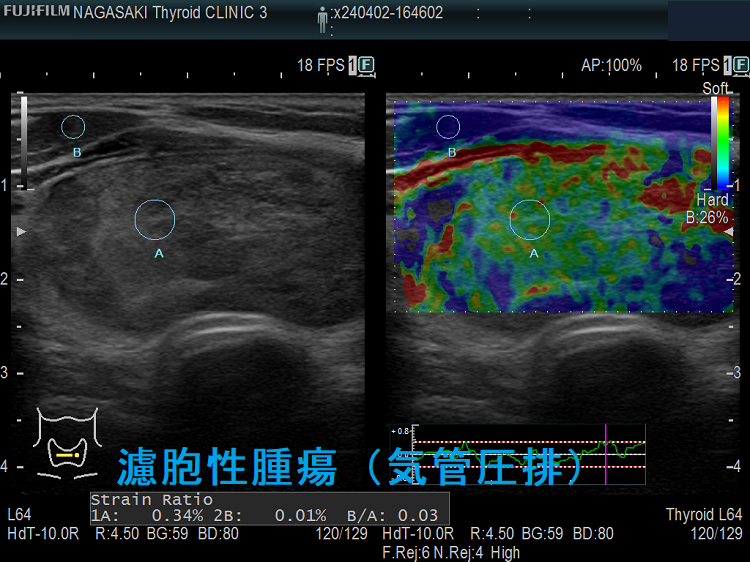 濾胞性腫瘍(気管圧排)エラストグラフィー 濾胞性腫瘍(気管圧排)エラストグラフィー