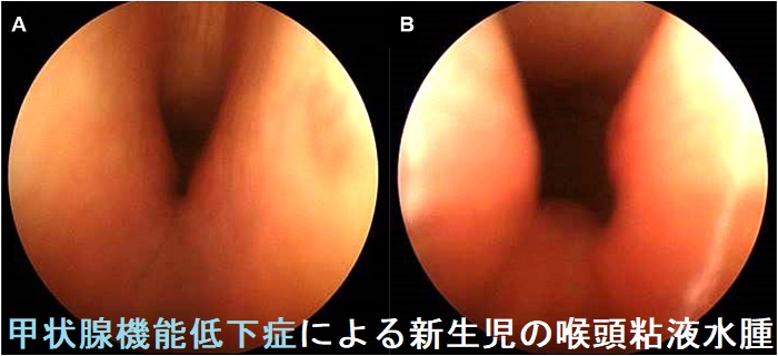 甲状腺機能低下症による新生児の喉頭粘液水腫 甲状腺機能低下症による新生児の喉頭粘液水腫