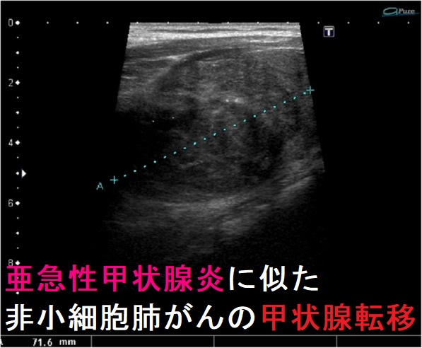 亜急性甲状腺炎に似た非小細胞肺がんの甲状腺転移 超音波(エコー)画像 亜急性甲状腺炎に似た非小細胞肺がんの甲状腺転移 超音波(エコー)画像
