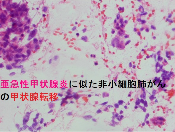 亜急性甲状腺炎に似た非小細胞肺がんの甲状腺転移 細胞診 亜急性甲状腺炎に似た非小細胞肺がんの甲状腺転移 細胞診