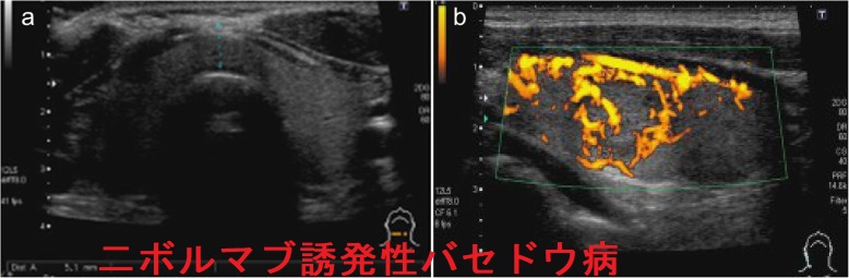 二ボルマブ誘発性バセドウ病 超音波(エコー)画像 二ボルマブ誘発性バセドウ病 超音波(エコー)画像