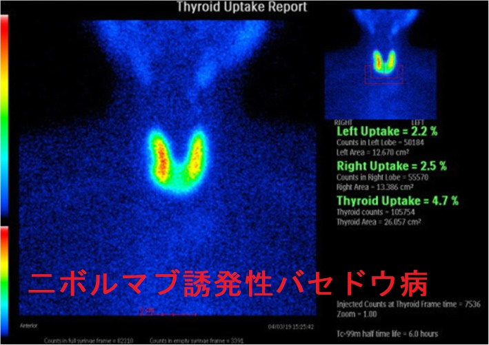 二ボルマブ誘発性バセドウ病 99mTc シンチグラフィー 二ボルマブ誘発性バセドウ病 99mTc シンチグラフィー
