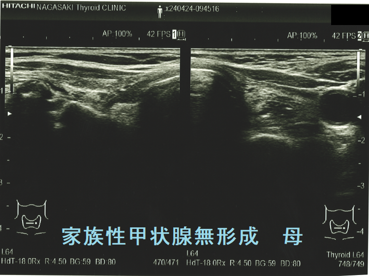 家族性甲状腺無形成 母 家族性甲状腺無形成 母