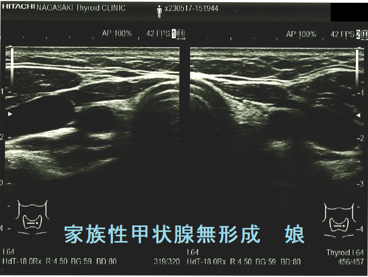 家族性甲状腺無形成 娘 家族性甲状腺無形成 娘