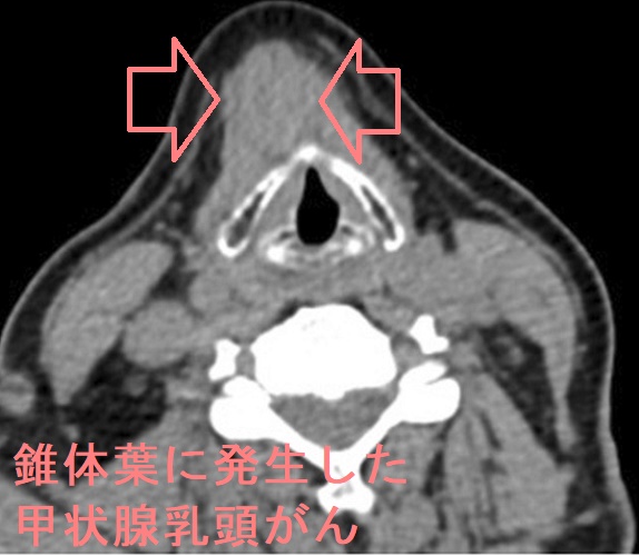 錐体葉に甲状腺乳頭がんが発生 錐体葉に甲状腺乳頭がんが発生
