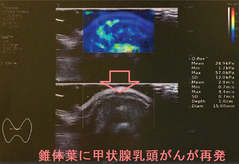 錐体葉に甲状腺乳頭がんが再発 錐体葉に甲状腺乳頭がんが再発