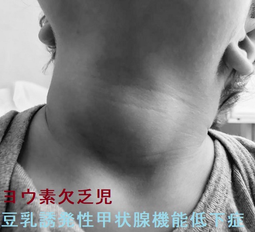 生後12か月のヨウ素欠乏児 豆乳誘発性甲状腺機能低下症 生後12か月のヨウ素欠乏児 豆乳誘発性甲状腺機能低下症