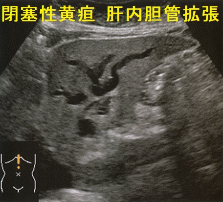 閉塞性黄疸 肝内胆管拡張 超音波(エコー)画像 閉塞性黄疸 肝内胆管拡張 超音波(エコー)画像