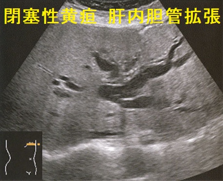 閉塞性黄疸 肝内胆管拡張 超音波(エコー)画像2 閉塞性黄疸 肝内胆管拡張 超音波(エコー)画像2