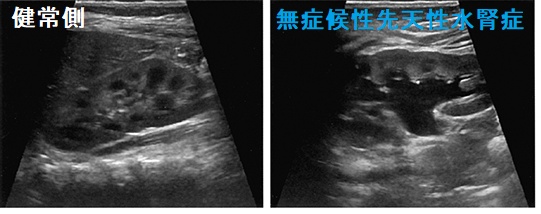 無症候性先天性水腎症 無症候性先天性水腎症