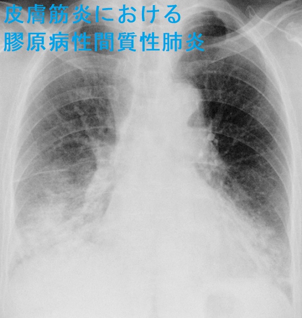皮膚筋炎における膠原病性間質性肺炎 胸部エックス線写真 皮膚筋炎における膠原病性間質性肺炎 胸部エックス線写真