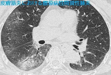 皮膚筋炎における膠原病性間質性肺炎 肺野条件の胸部単純CT1 皮膚筋炎における膠原病性間質性肺炎 肺野条件の胸部単純CT1