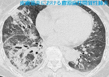 皮膚筋炎における膠原病性間質性肺炎 肺野条件の胸部単純CT2 皮膚筋炎における膠原病性間質性肺炎 肺野条件の胸部単純CT2