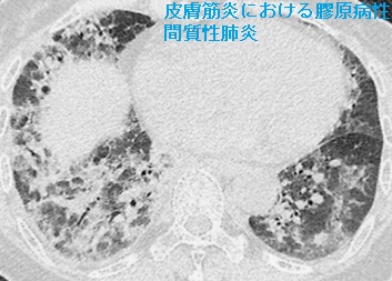 皮膚筋炎における膠原病性間質性肺炎 肺野条件の胸部単純CT3 皮膚筋炎における膠原病性間質性肺炎 肺野条件の胸部単純CT3