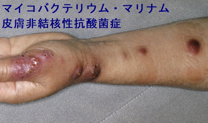 マイコバクテリウム・マリナム 皮膚非結核性抗酸菌症 マイコバクテリウム・マリナム 皮膚非結核性抗酸菌症