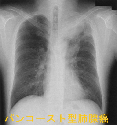 パンコースト腫瘍(Pancoast腫瘍) 胸部エックス線写真 パンコースト腫瘍(Pancoast腫瘍) 胸部エックス線写真