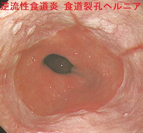 逆流性食道炎 食道裂孔ヘルニア 内視鏡画像 逆流性食道炎 食道裂孔ヘルニア 内視鏡画像